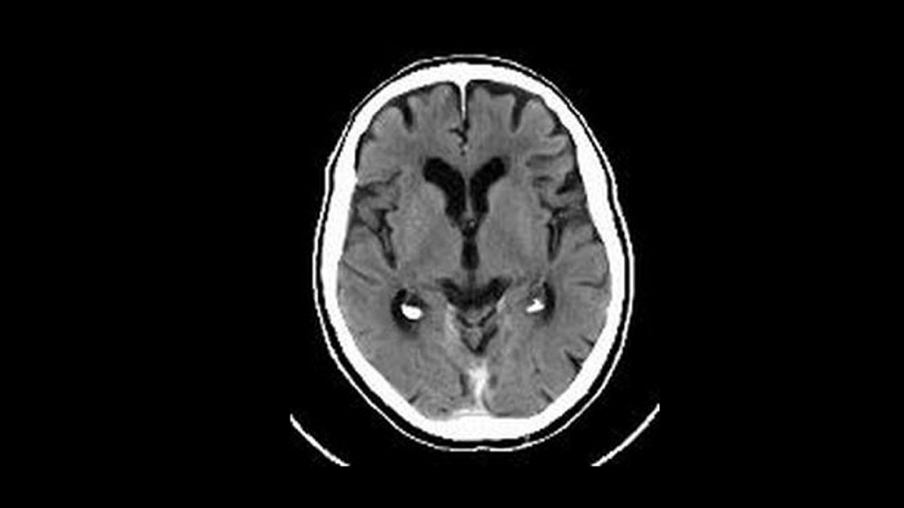 Brain Scan (example of scarred brain)